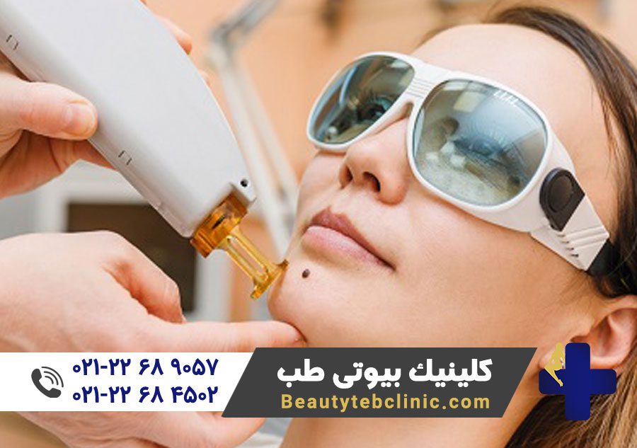 برداشتن خال صورت | برداشتن خال گردن | برداشتن خال بدن | جوانسازی پوست | بازسازی پوست | پزشک متخصص لیزر | لیزر درمانی